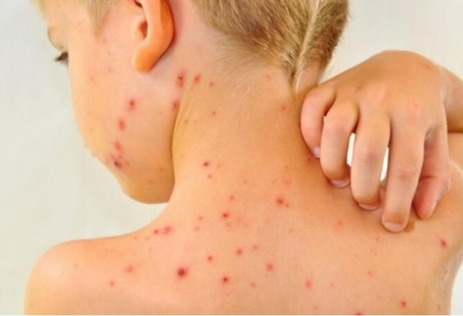 Bijeljina prijavila epidemiju morbila